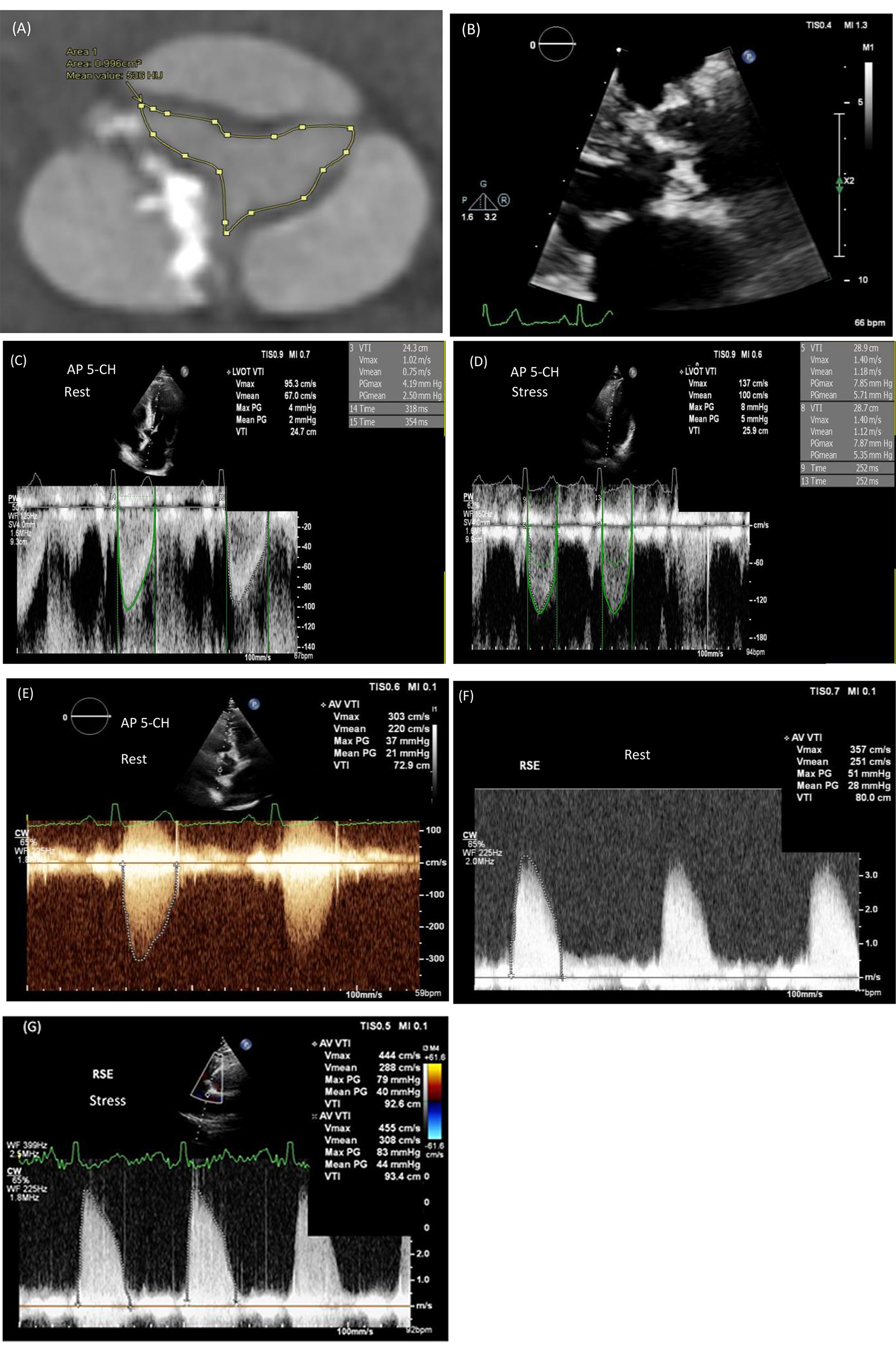 Right parasternal view in dobutamine stress echocardiography for aortic stenosis assessment