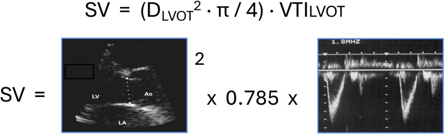 Navigating the Waves of Critical Care Echocardiography: Unveiling its Role, Advantages, and Pitfalls in the Cardiac Intensive Care Unit