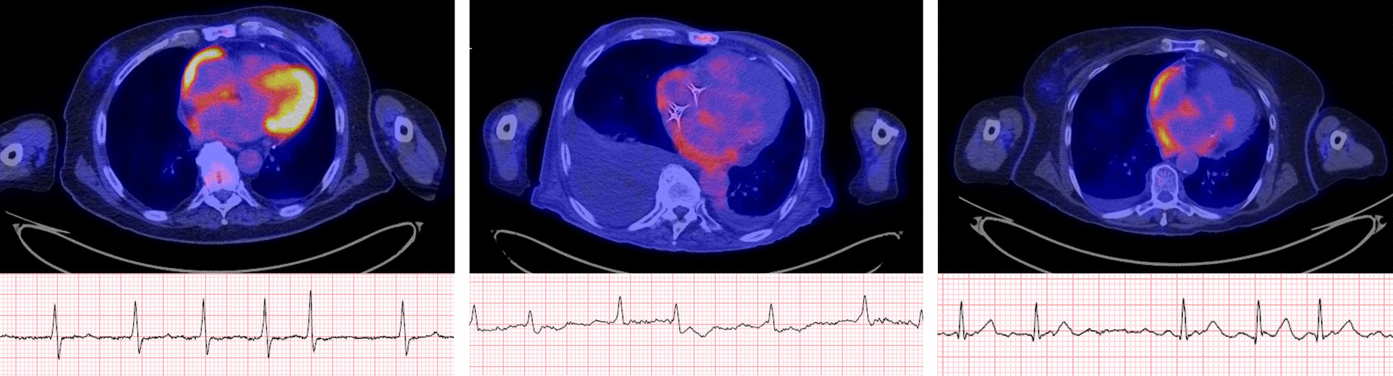 Atrial FDG Uptake: Etiologies, Clinical Significance, and Implications