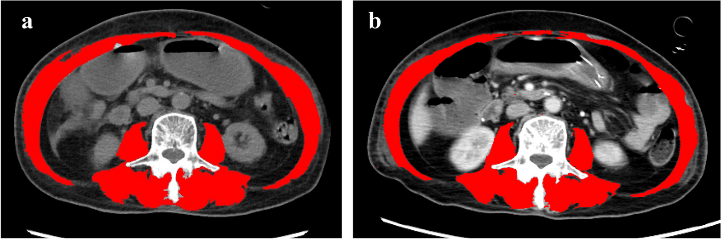 Early urea-to-creatinine ratio to predict rapid muscle loss in critically ill patients with sepsis: a single-center retrospective observational study