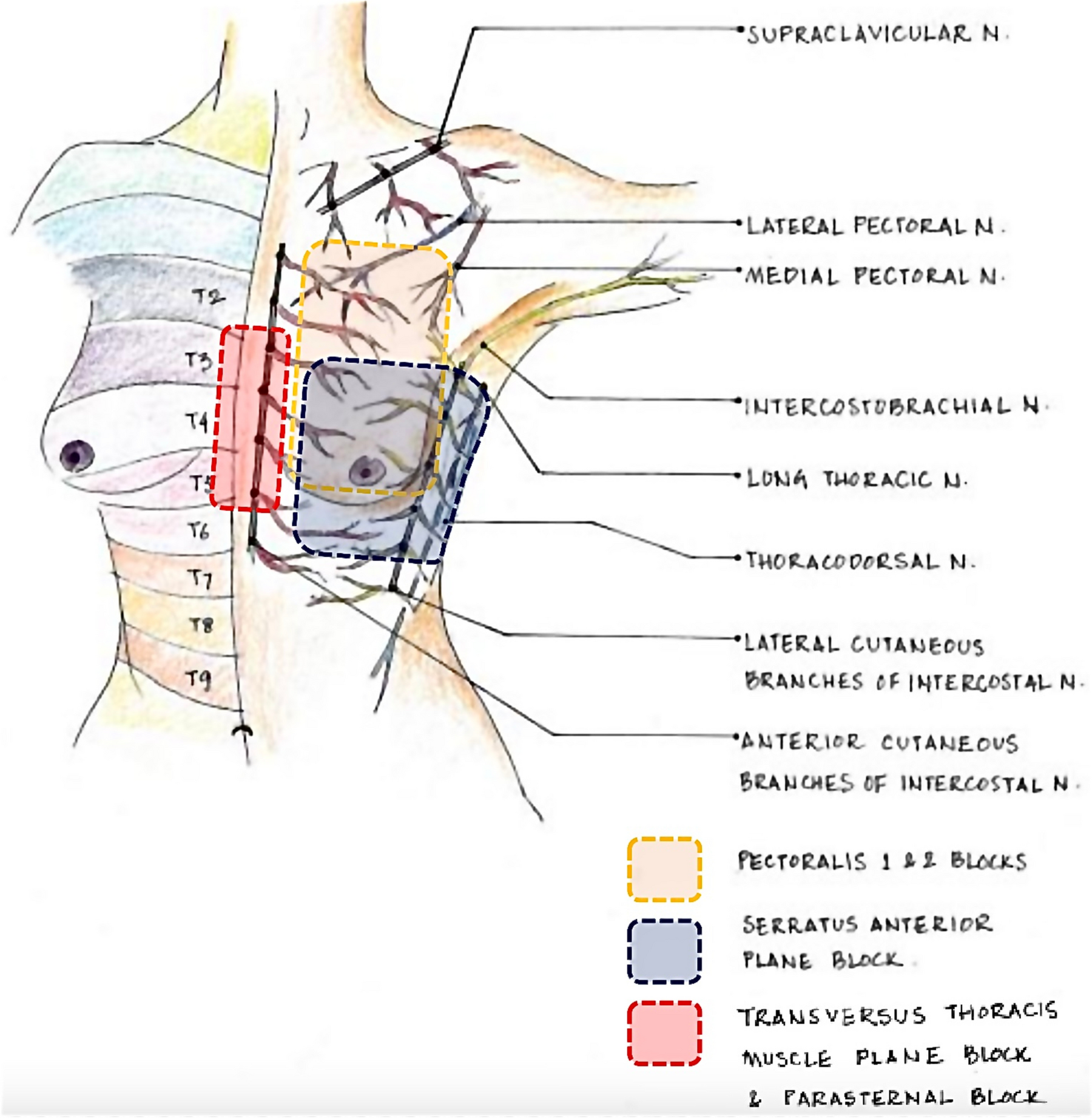 The Role of Regional Anesthesia in ICU Pain Management