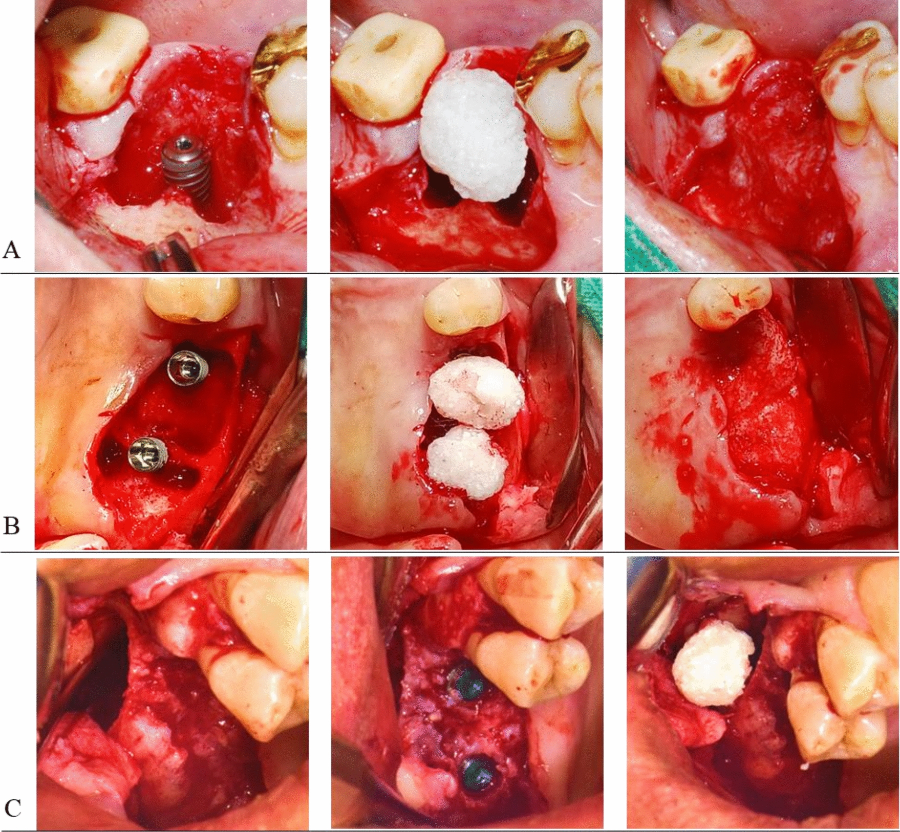 Reducing Healing Period with DDM/rhBMP-2 Grafting for Early Loading in Dental Implant Surgery