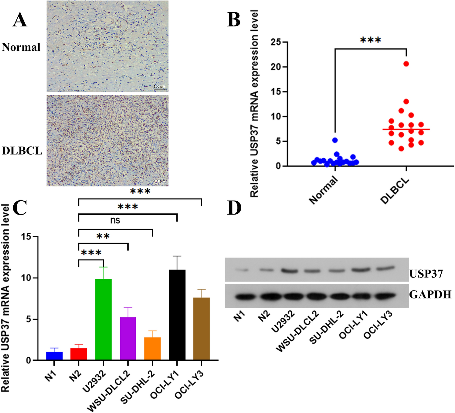 USP37 promotes diffuse large B-cell lymphoma progression by deubiquitinating and stabilizing c-myc