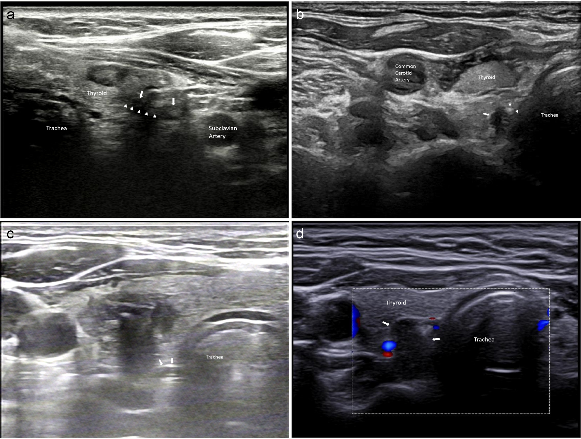 Gross recurrent laryngeal nerve invasion by extranodal extension in thyroid carcinoma