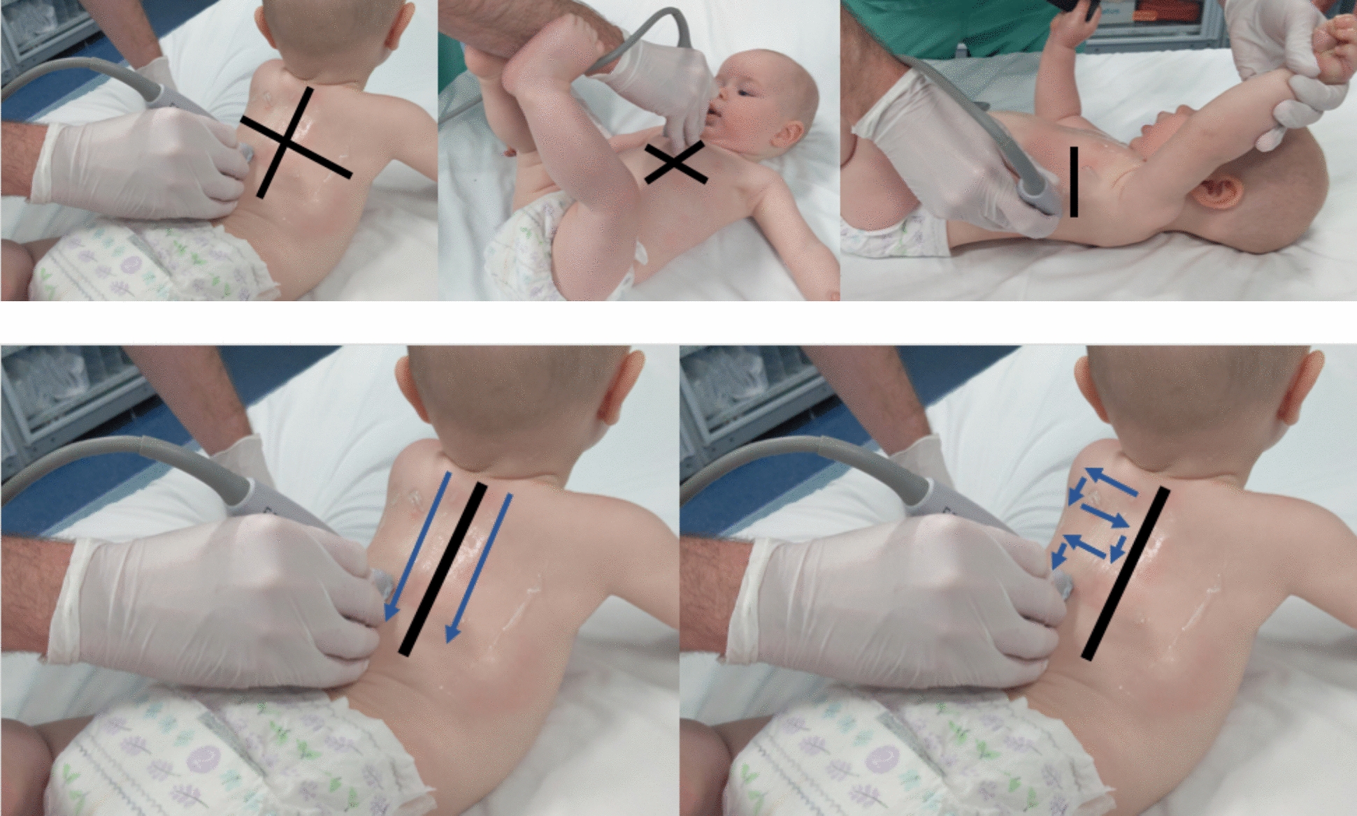 Comparison of two point-of-care lung ultrasound techniques and their associated outcomes for bronchiolitis in the pediatric emergency department