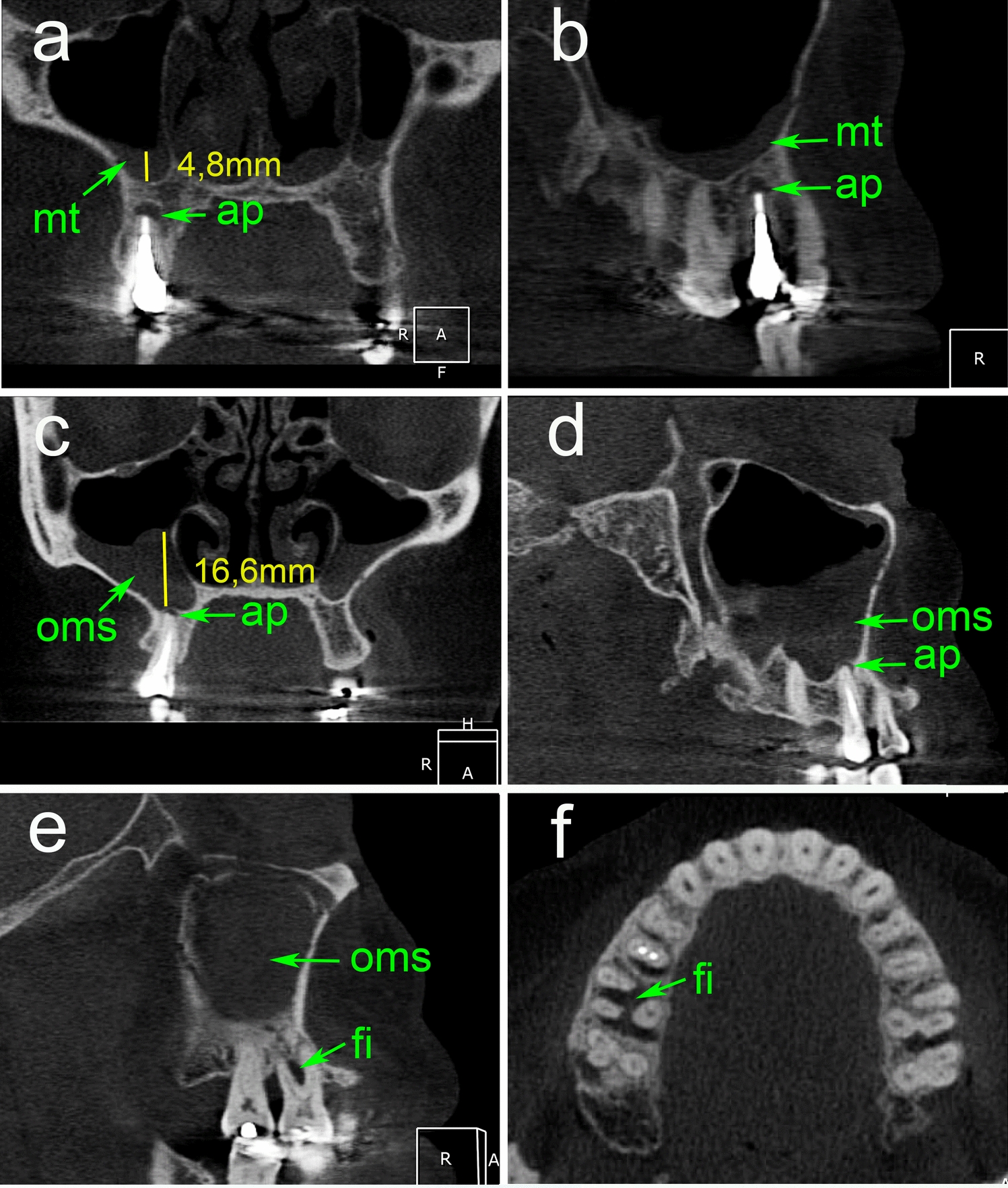 Dental maxillary sinus pathology: a CBCT-based case–control study
