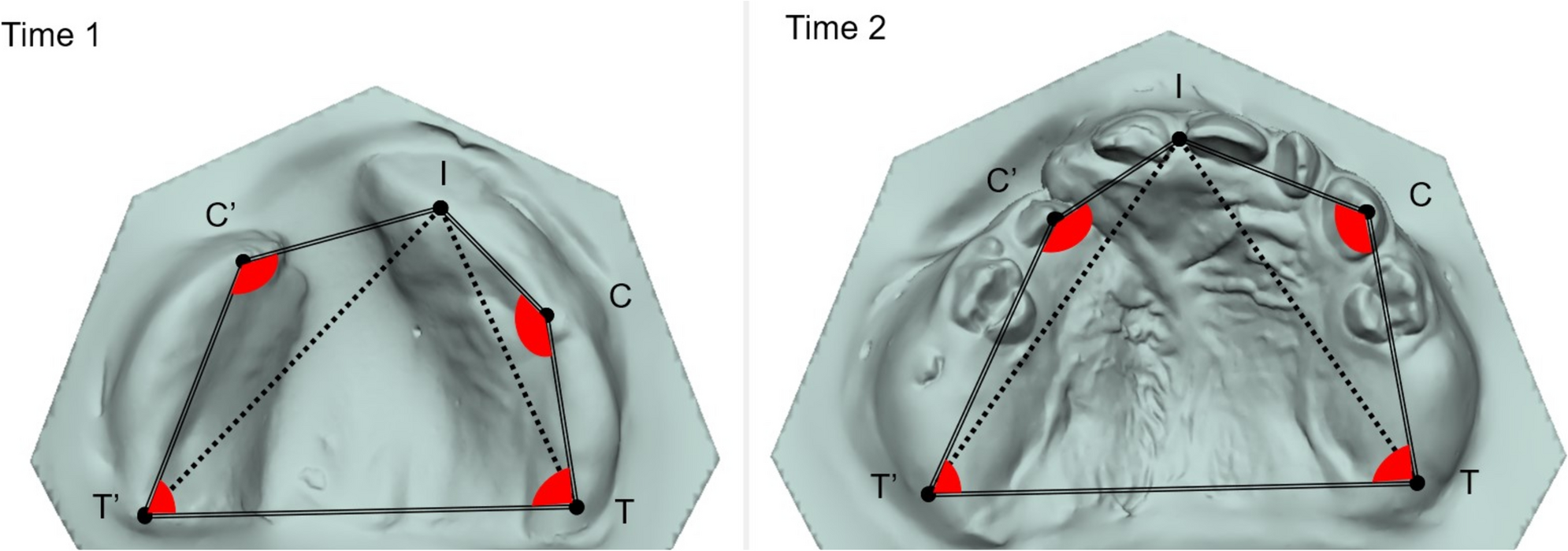 Palatal symmetry analysis of surgical protocols for oral clefts by 3D stereophotogrammetry