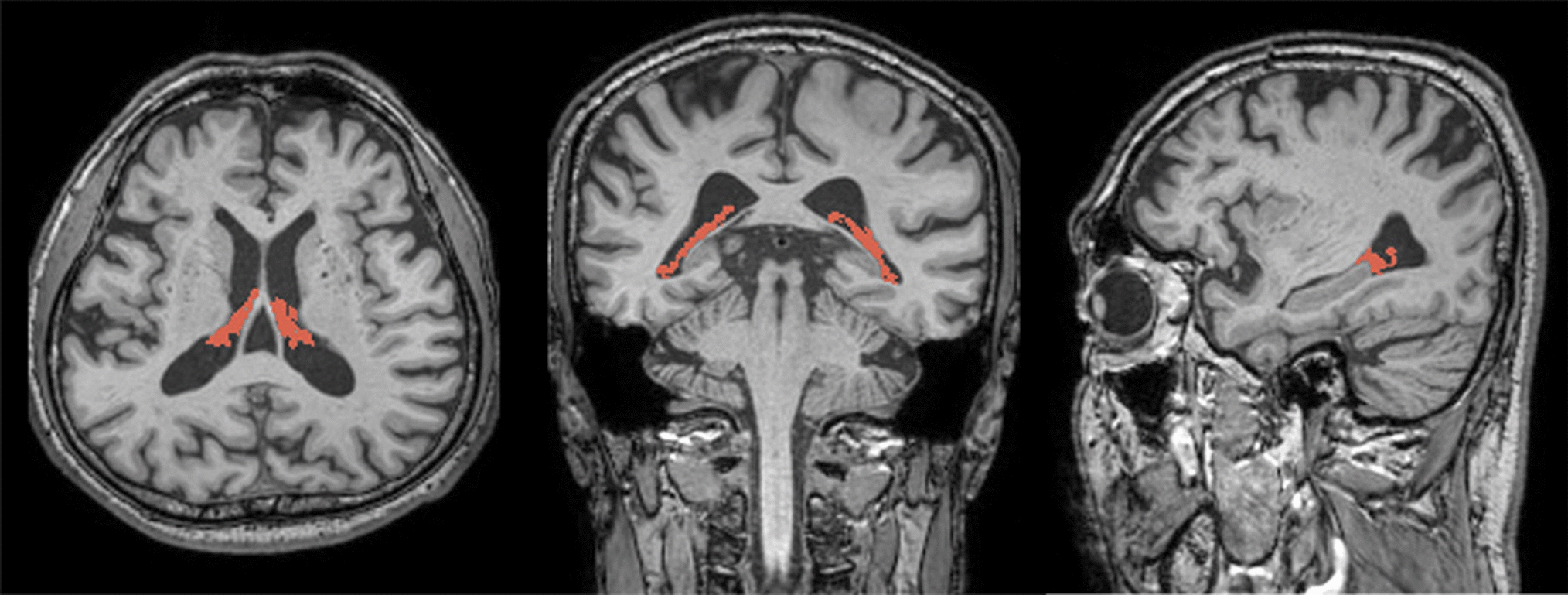 Choroid plexus enlargement in patients with rapid eye movement sleep behavior disorder: relevance to glymphatic system dysfunction