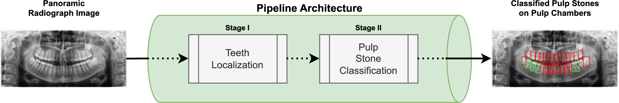 A novel deep learning-based pipeline architecture for pulp stone detection on panoramic radiographs