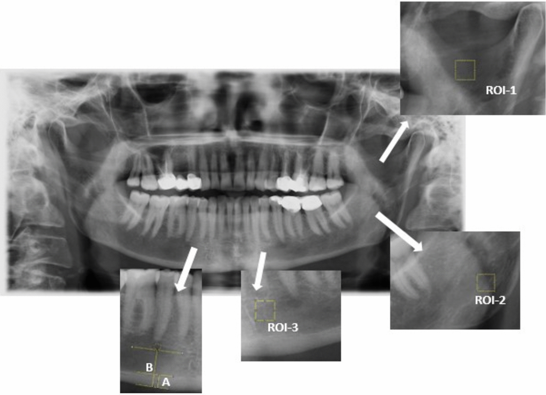A retrospective comparative fractal and radiomorphometric analysis of the effect of bisphosphonate use pattern and duration on the mandible