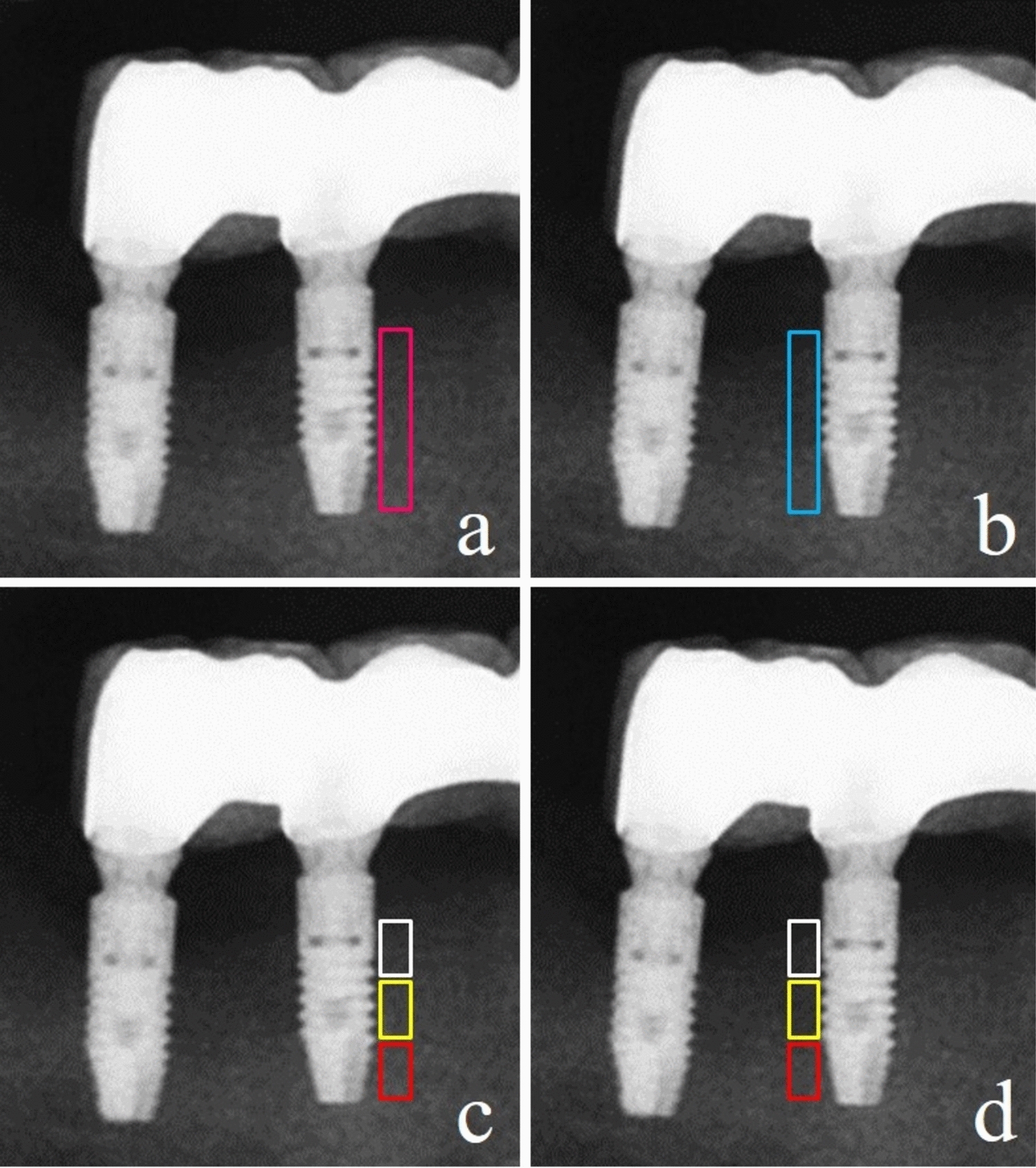 Fractal dimension, lacunarity, and bone area fraction analysis of peri-implant trabecular bone after prosthodontic loading