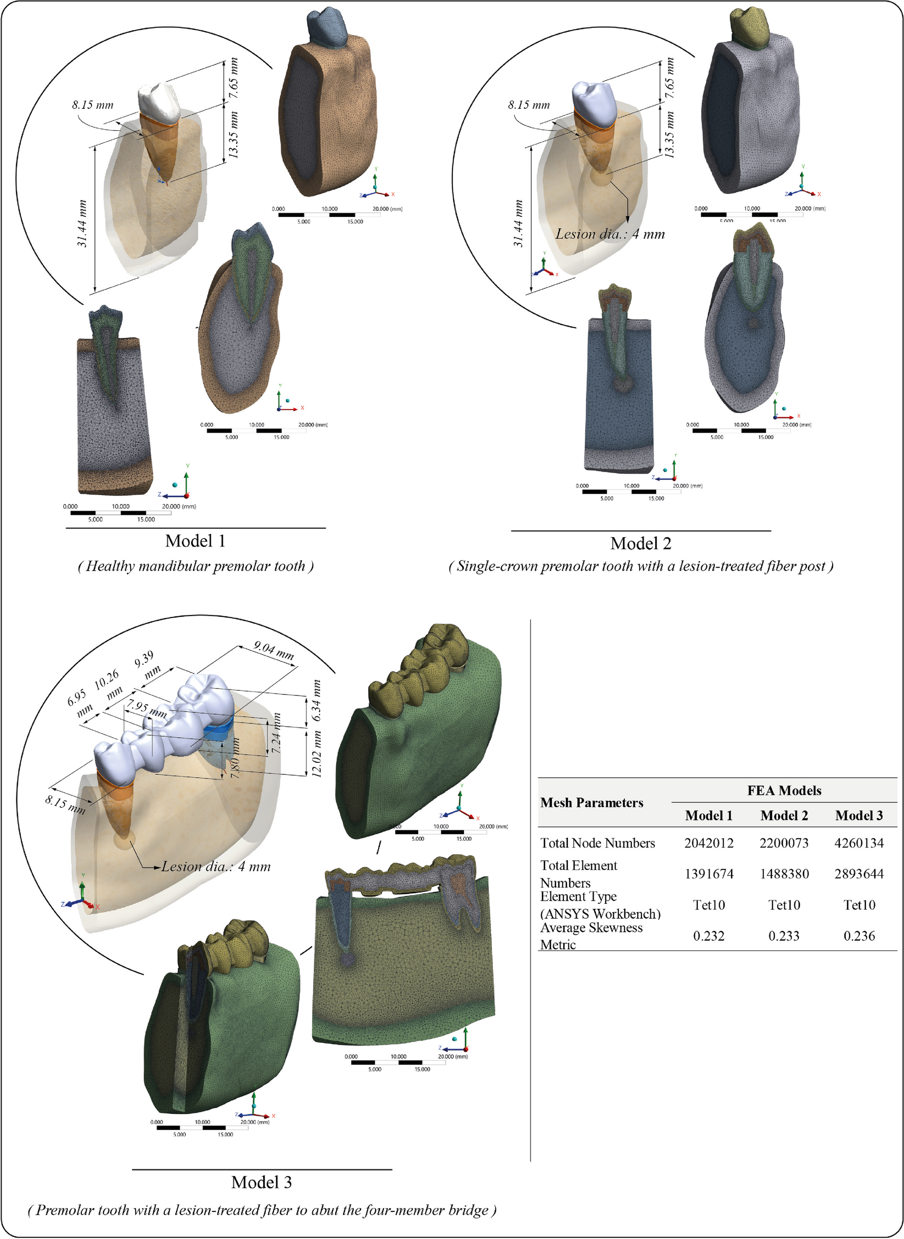 Evaluation of stress patterns in teeth with endodontic treatment and periapical lesions as abutments for fixed prosthesis: a finite element analysis study