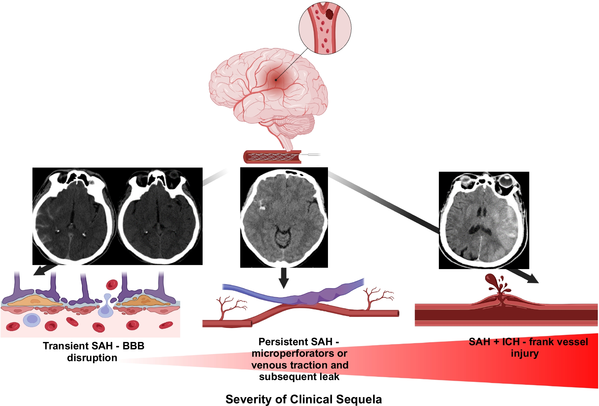Stroke endovascular thrombectomy related subarachnoid hyperdensity: incidence, predictive factors, and a proposed sub-classification