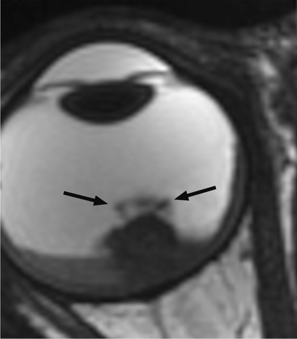 Retinoblastoma and beyond: pediatric orbital mass lesions