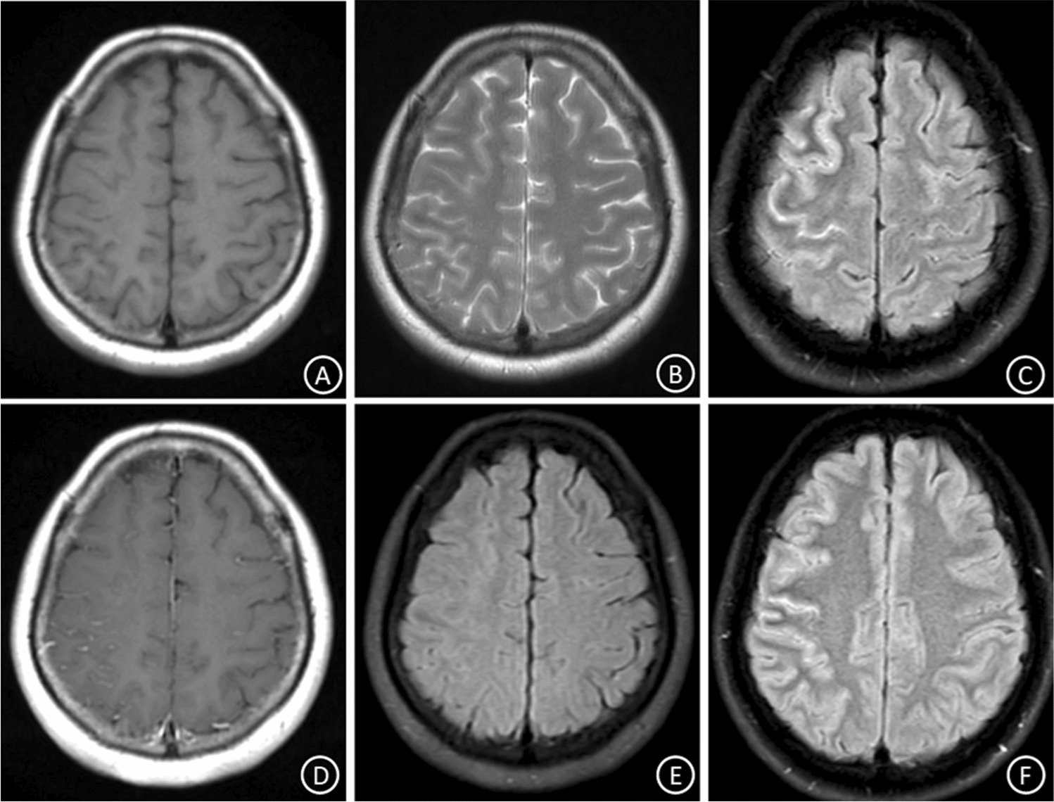 Clinical features of recurrent MOG antibody-associated cortical encephalitis in adults