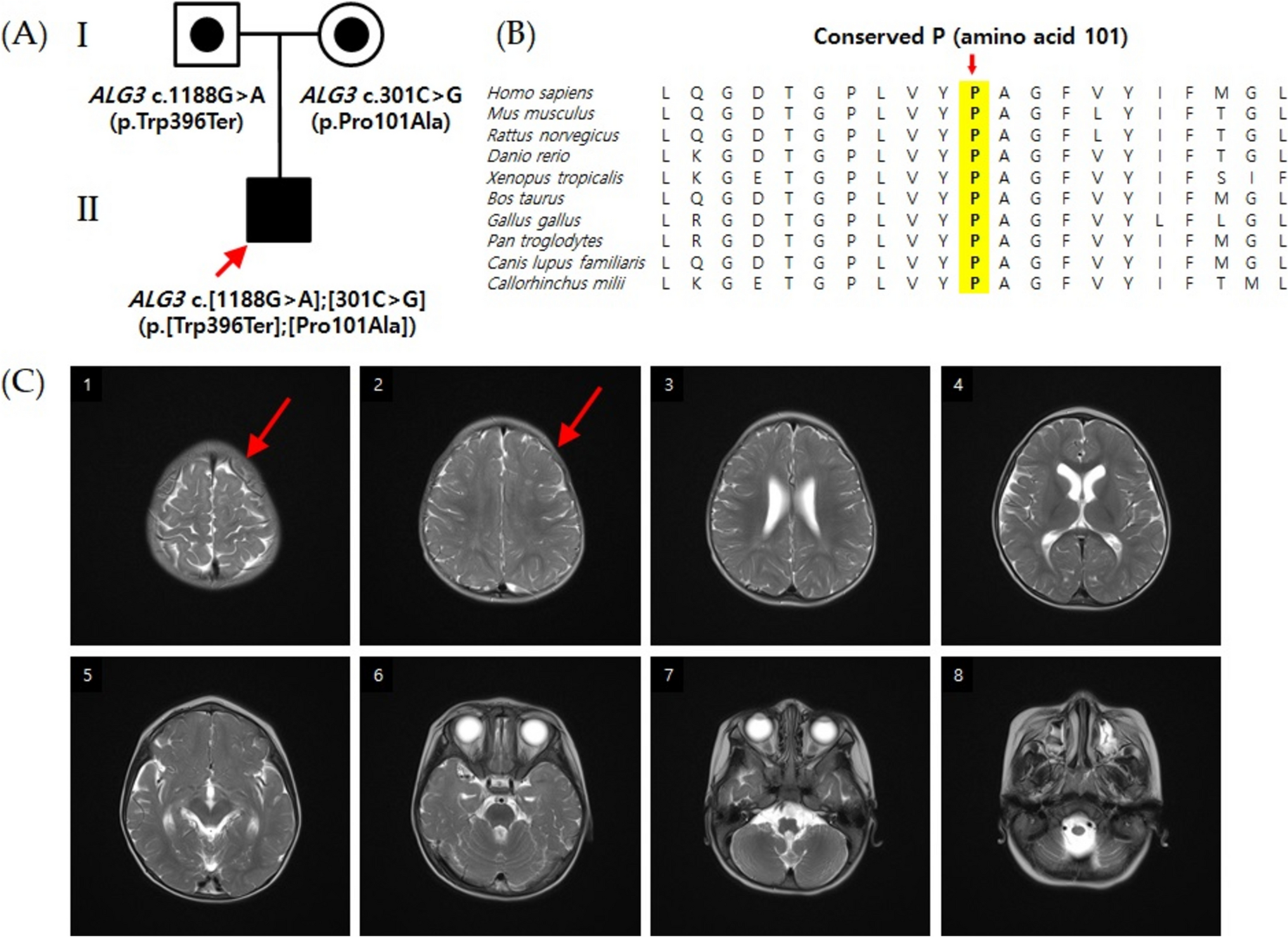 First case report of effective and safe application of cannabidiol to treat concurrent ALG3-CDG and Lennox–Gastaut Syndrome