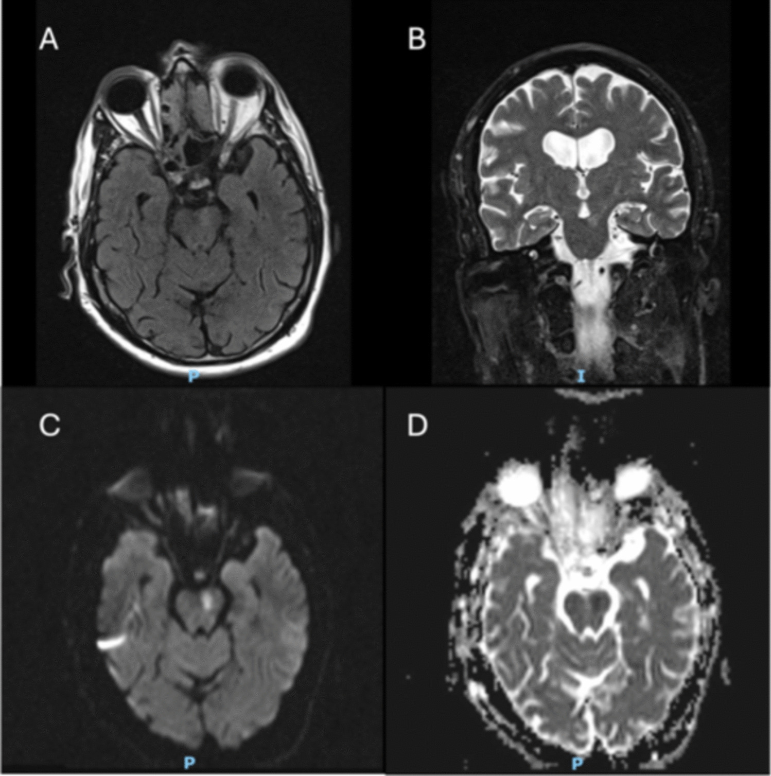 Another stroke in the wall: a case of ischemic wall-eyed bilateral internuclear ophthalmoplegia (WEBINO)