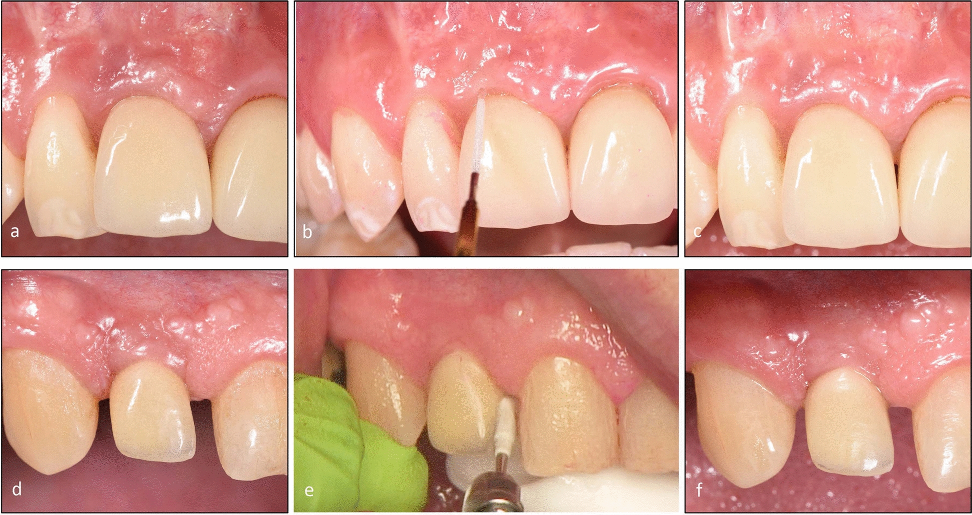 Treatment of peri-implant mucositis using an Er:YAG laser or an ultrasonic device: a randomized, controlled clinical trial