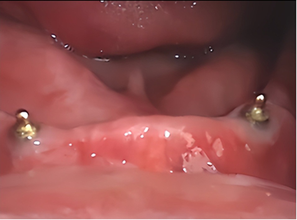 Effect of nanogold incorporation into polymethyl methacrylate denture bases on microbial activity in implant-retained mandibular overdentures
