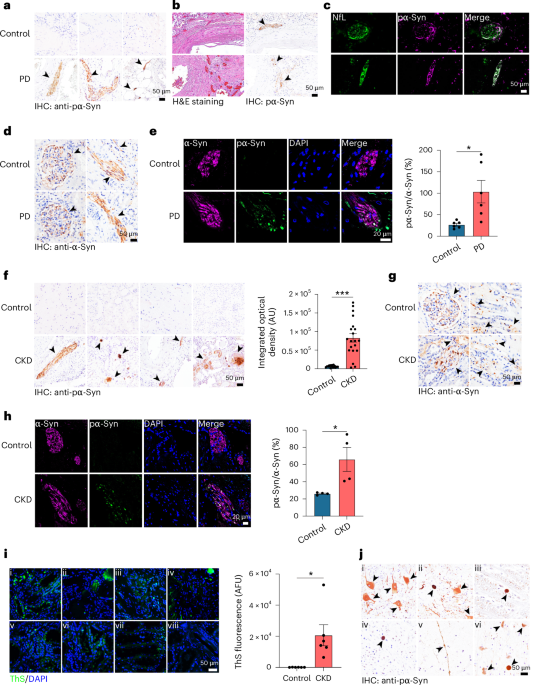 Propagation of pathologic α-synuclein from kidney to brain may contribute to Parkinson’s disease