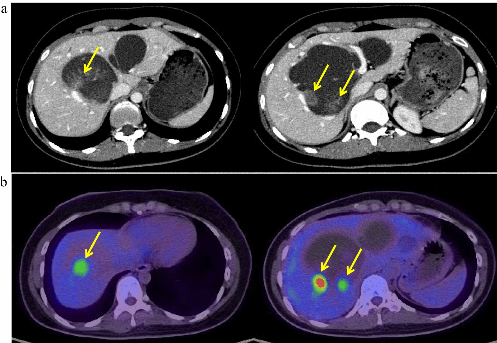 A case of simultaneous pancreatoduodenectomy and living donor liver transplantation for biliary cancer complicated with congenital biliary dilatation