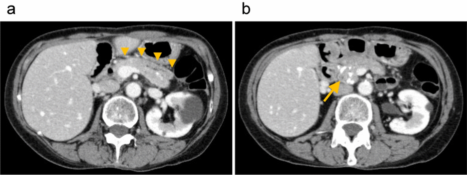 Simplified technique in total pancreatectomy with islet cell autotransplantation after Frey’s procedure: a case report