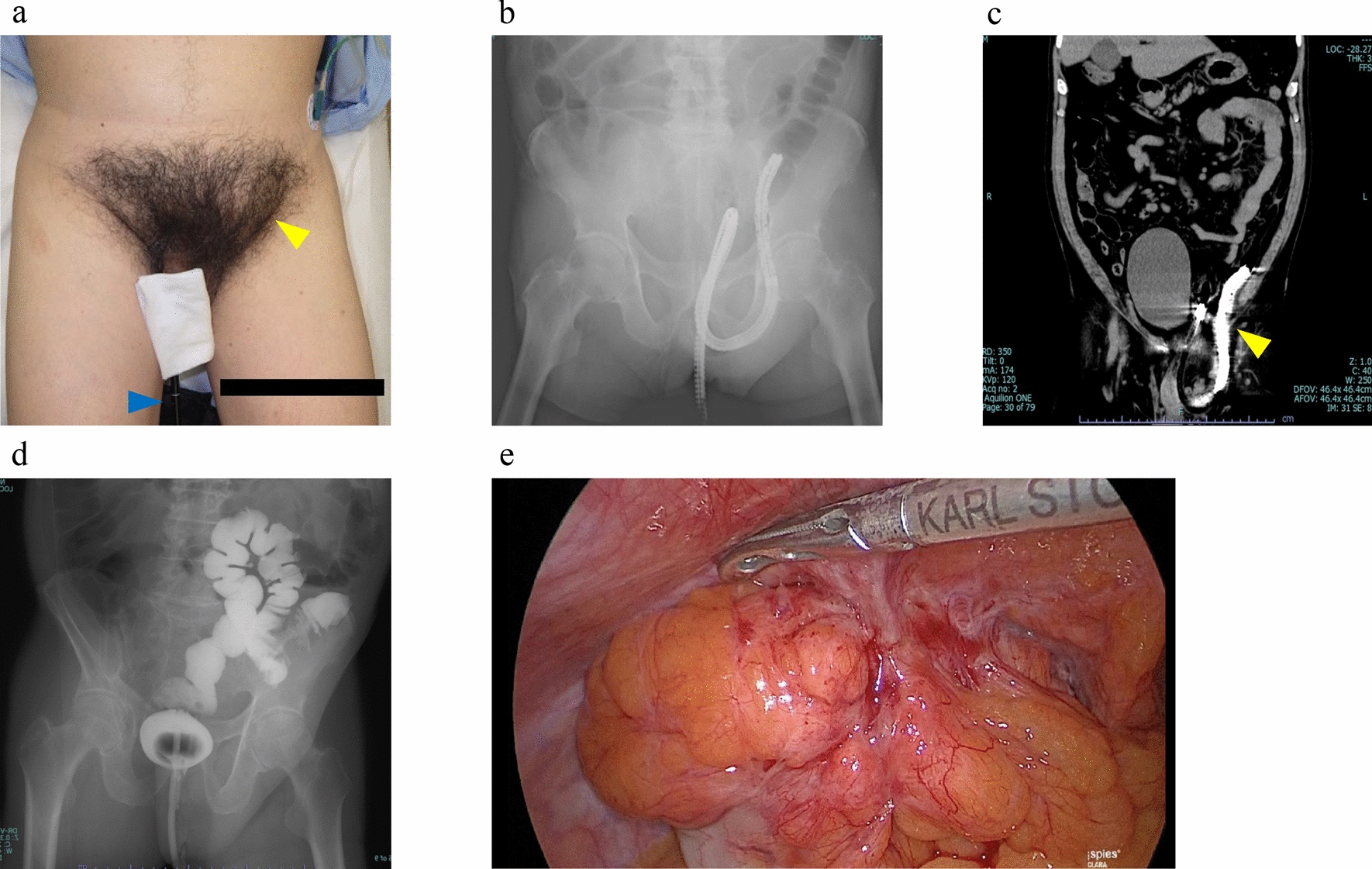 Treatment of a left inguinal hernia with incarceration of the scope during colonoscopy: a case report and literature review