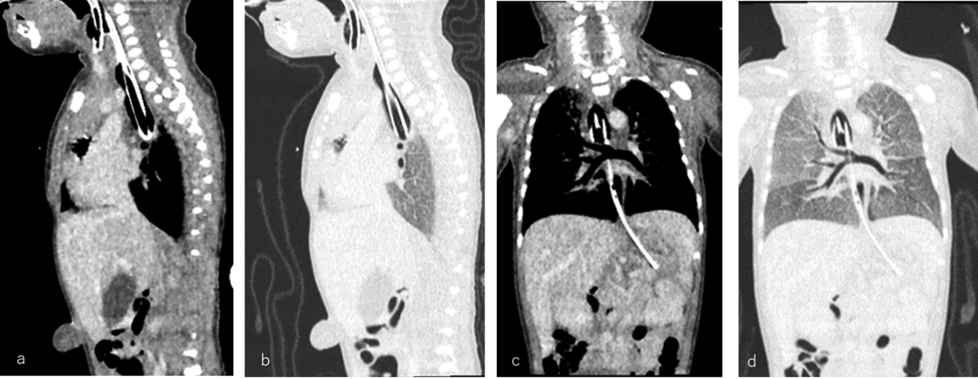A case report of type II Floyd tracheal agenesis with staged tracheal and alimentary reconstructions