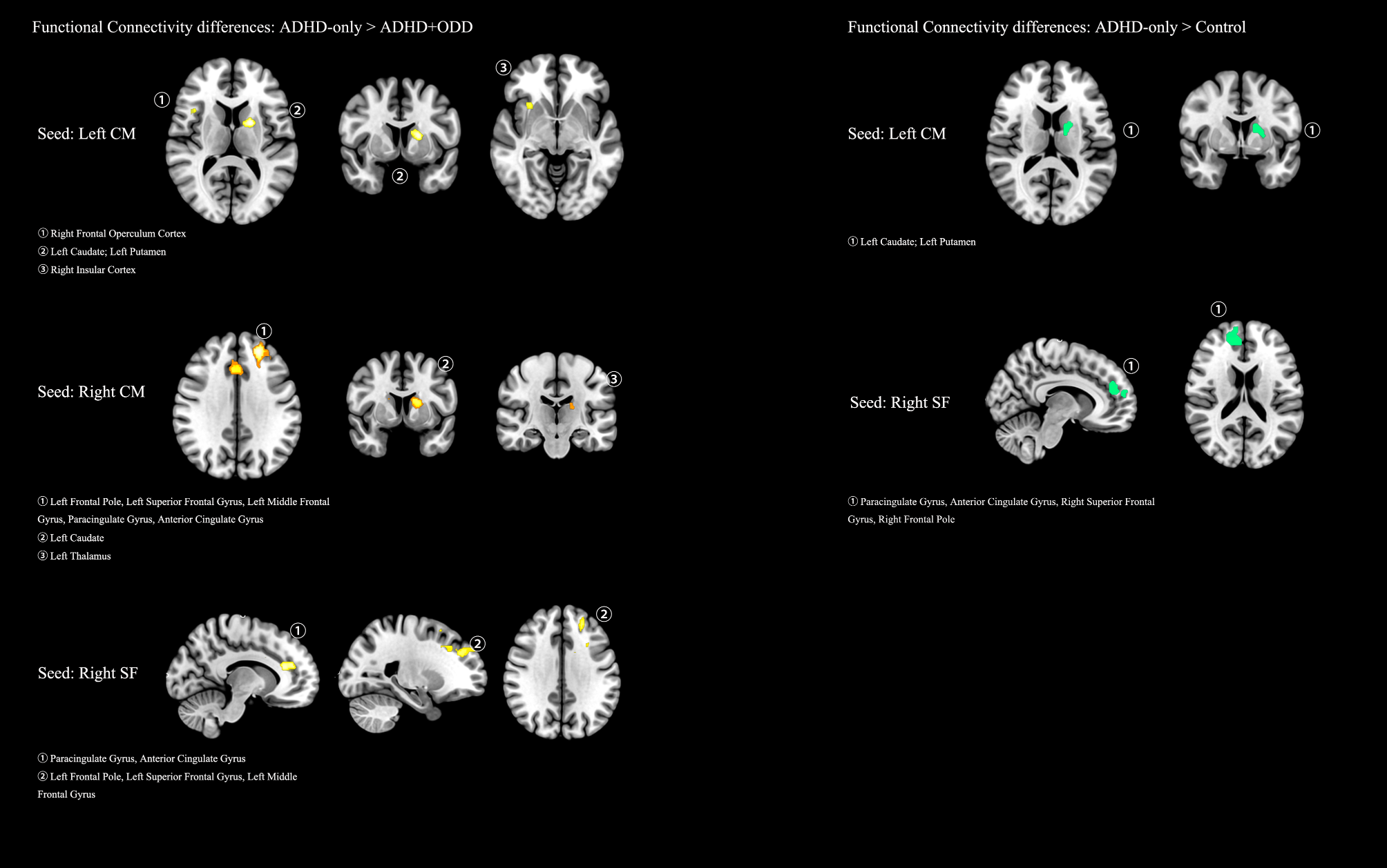 Functional and structural connectivity of the subregions of the amygdala in ADHD children with or without ODD