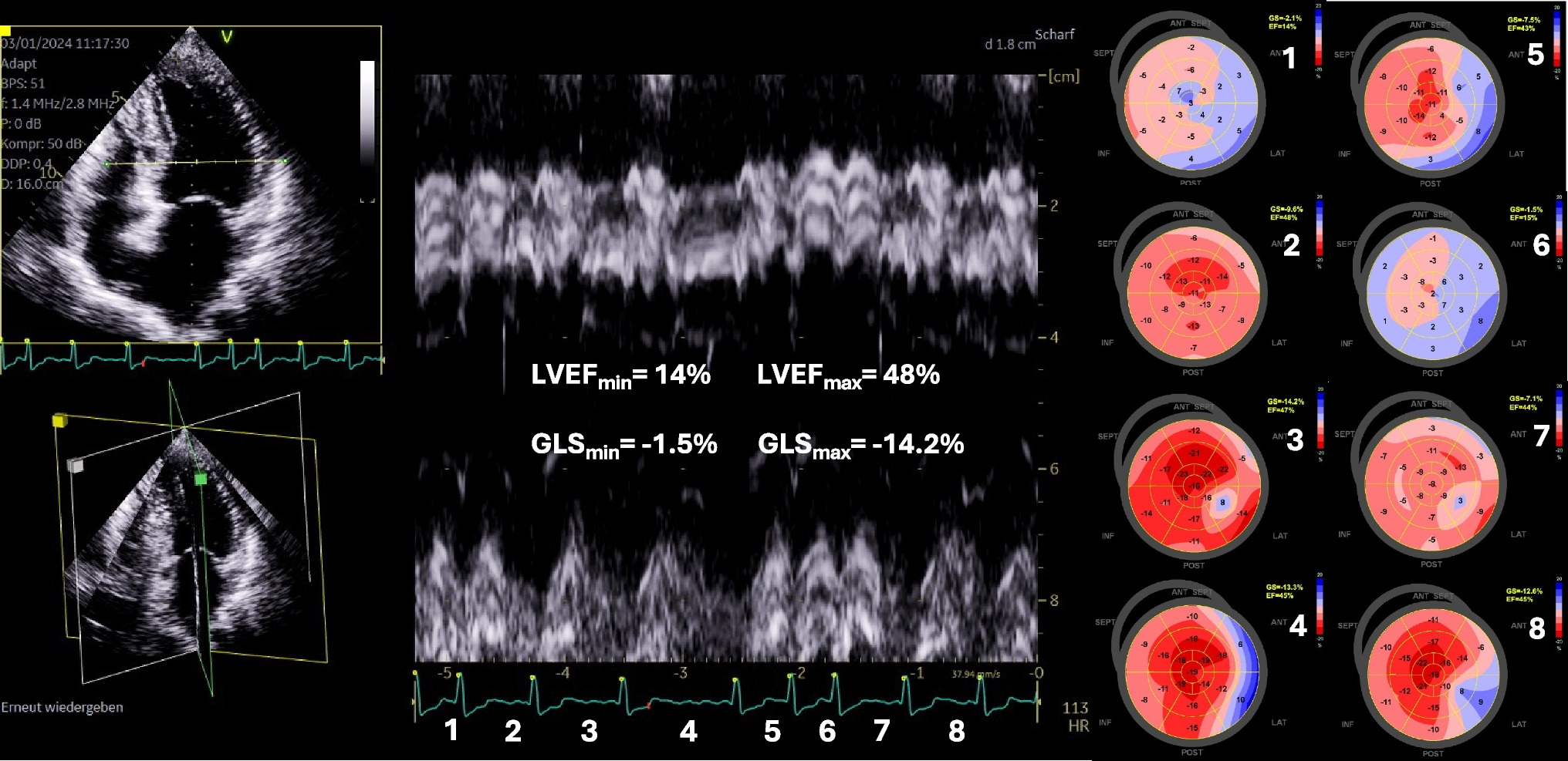 Echocardiographic assessment of atrial, ventricular, and valvular function in patients with atrial fibrillation—an expert proposal by the german working group of cardiovascular ultrasound