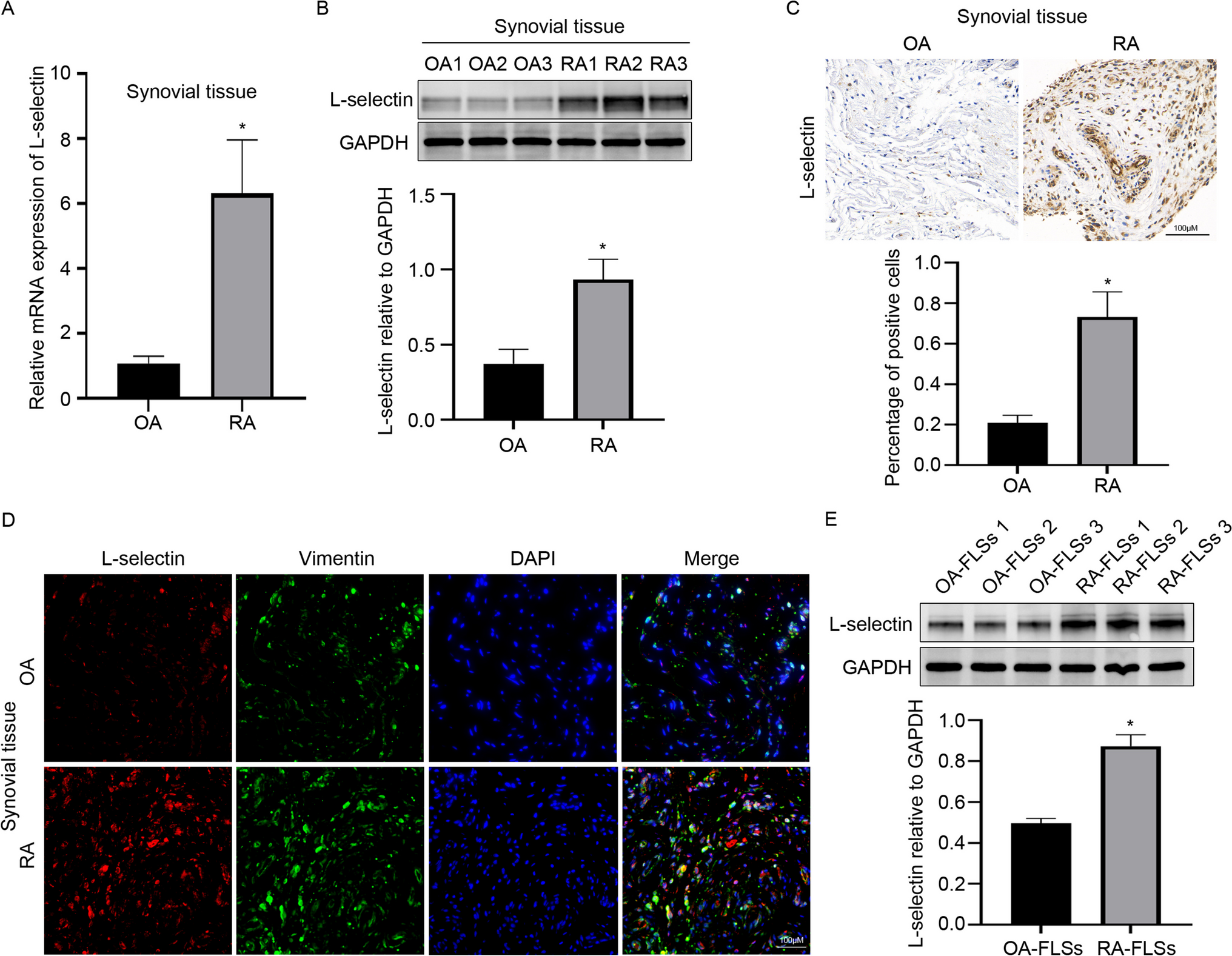 L-selectin Promotes Migration, Invasion and Inflammatory Response of Fibroblast-Like Synoviocytes in Rheumatoid Arthritis via NF-kB Signaling Pathway