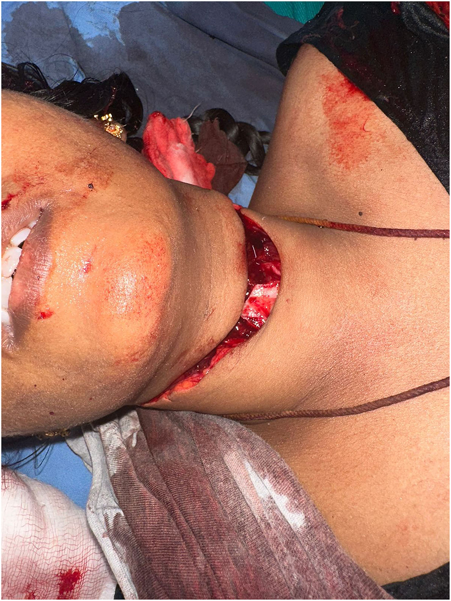 Lifesaving surgical approaches for severe penetrating knife injury to the neck