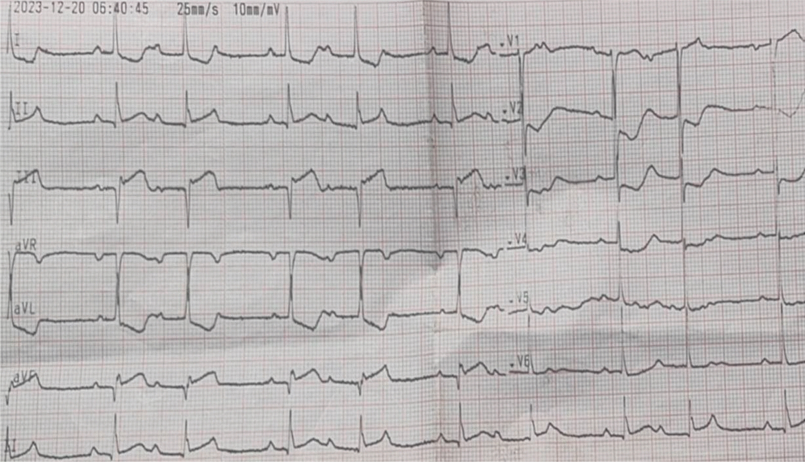 Interventricular septal dissection secondary to acute inferior myocardial infarction: case series and literature review