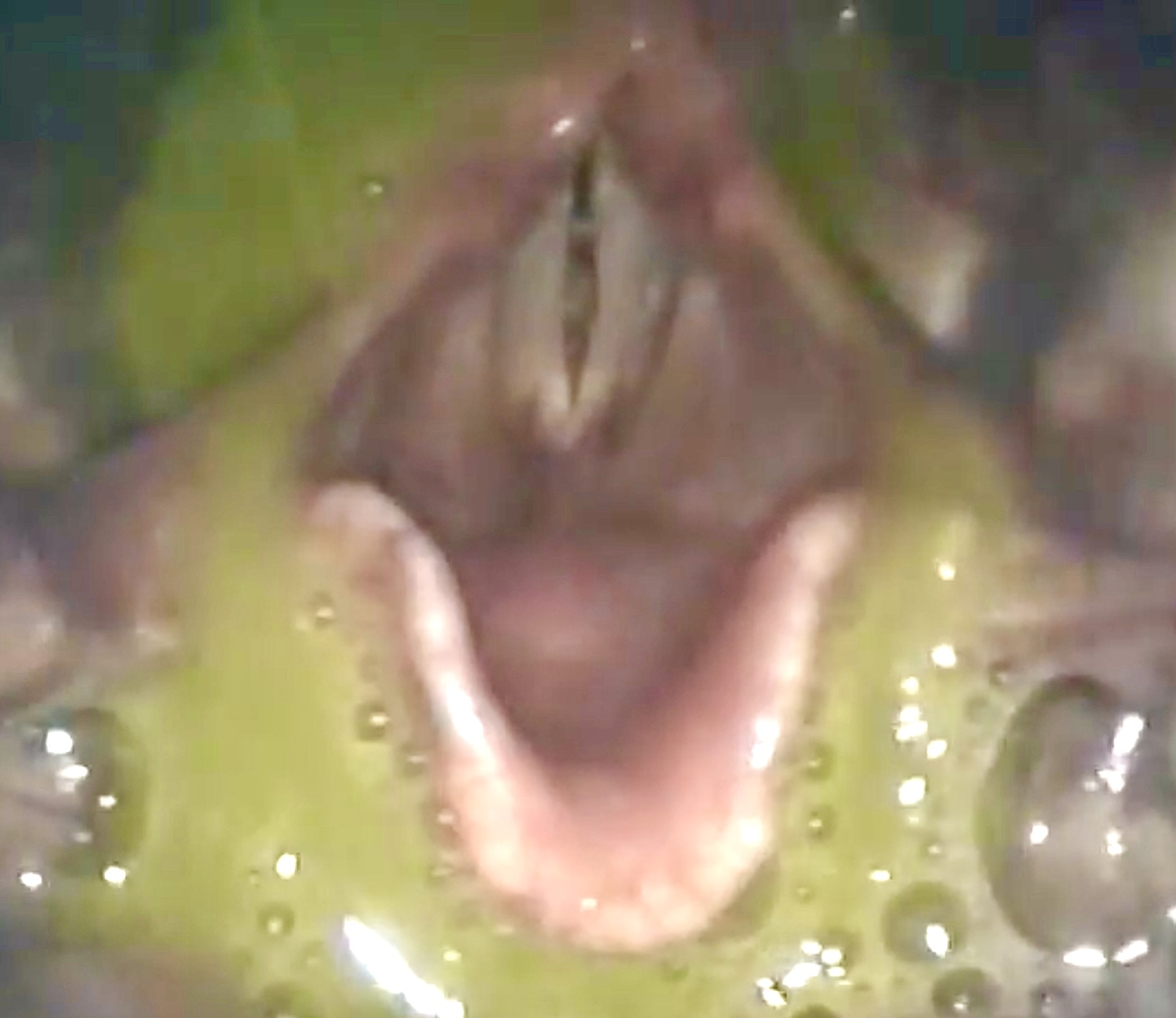 Enhancing Voice and Swallowing: A Cross-Sectional Study on Percutaneous Injection Medialisation Laryngoplasty Outcomes in Patients of Unilateral Vocal Cord Palsy