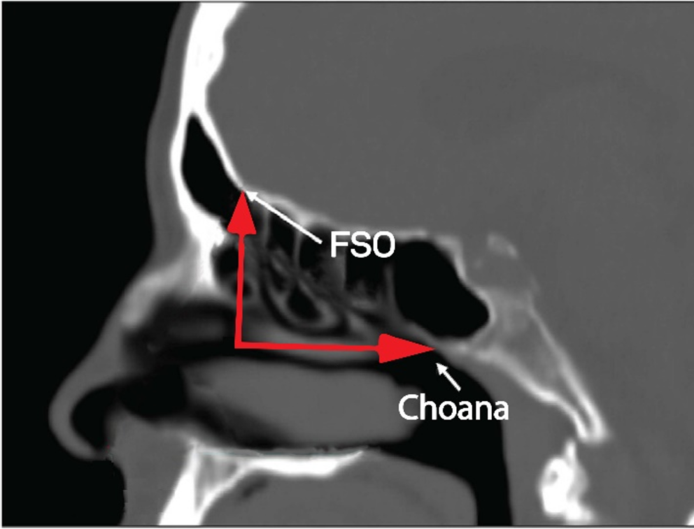 Radiological Correlation Between the Frontal Sinus Ostium and the Nasal Choana