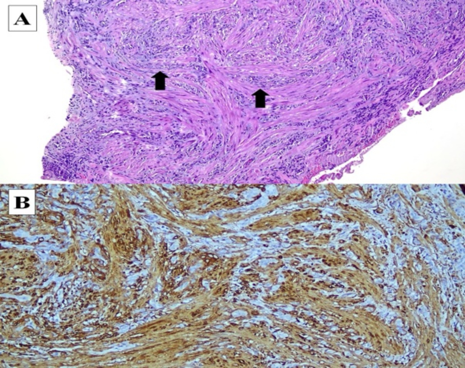 Angioleiomyoma of the Inferior Turbinate: Case Report and Review of the Literature