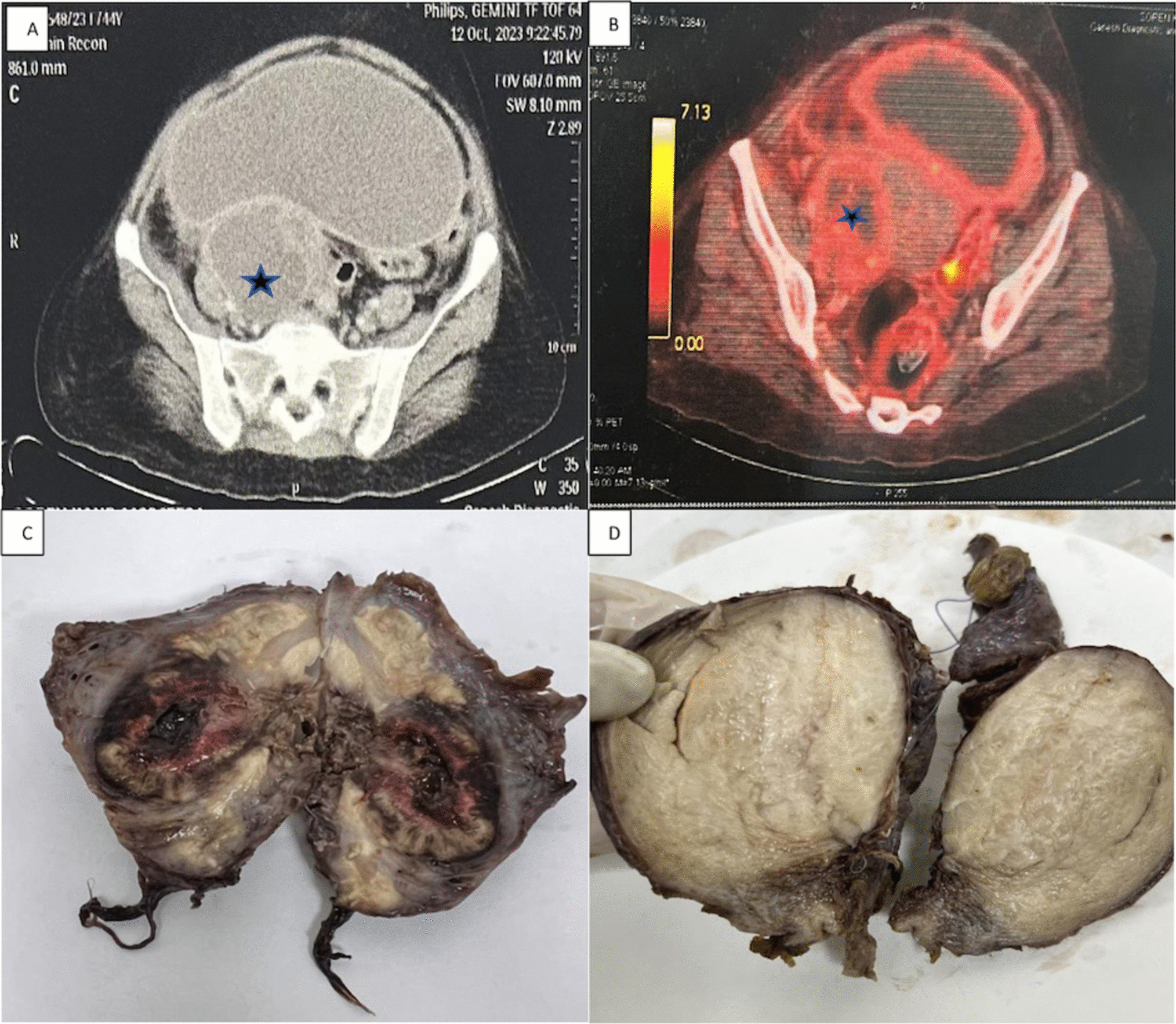 A Rare Case of Xanthogranulomatous Salpingo-Oophritis Simulating Ovarian Malignancy with Associated Endometriosis and Uterine Adenomyosis