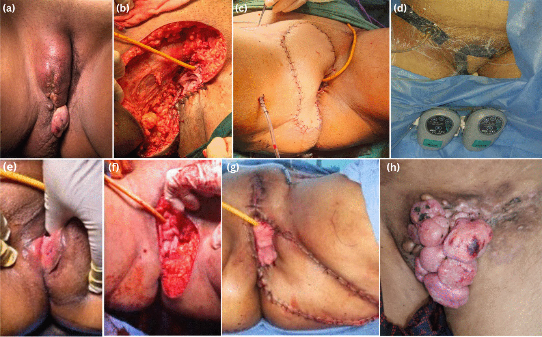 Navigating the Complexity of Rare Vulvar Masses—a Case Series