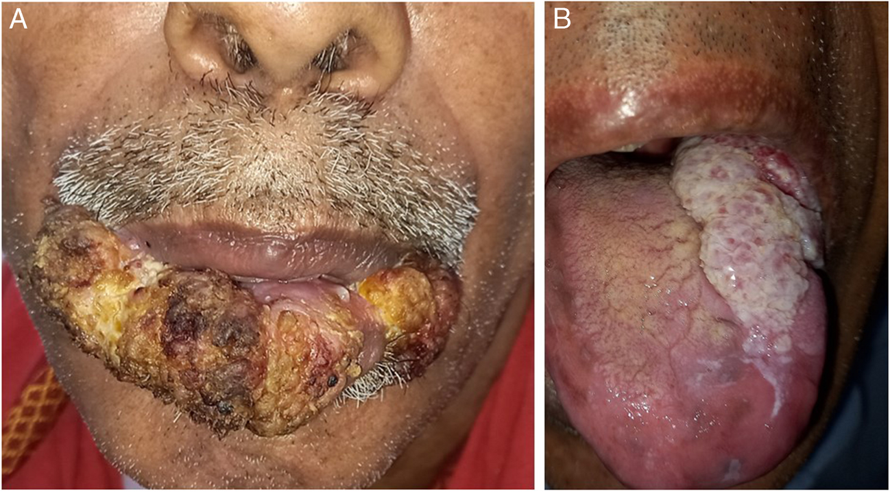 Clinicopathological Study of Factors Influencing Outcomes in Oral Verrucous Lesions