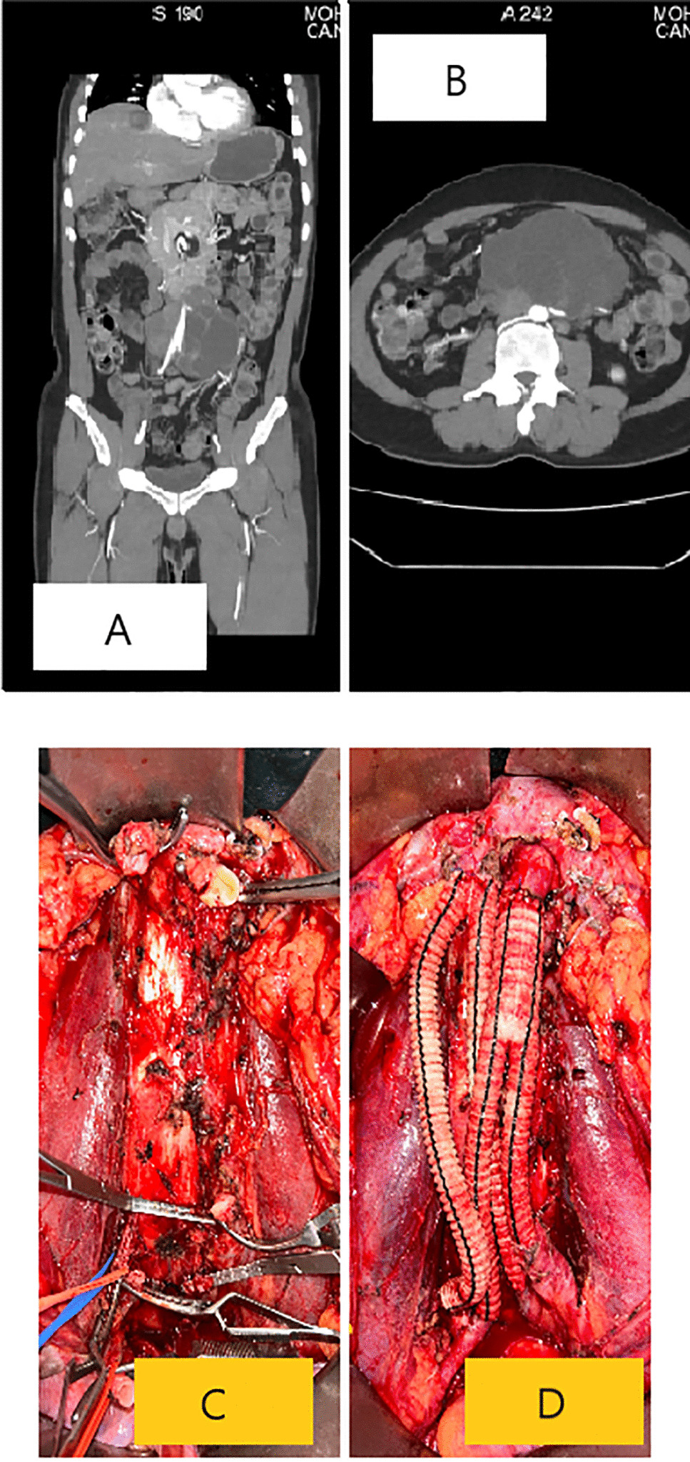 Desperate Times Require Desperate Measures: Major Vascular Resection in Desperate RPLND