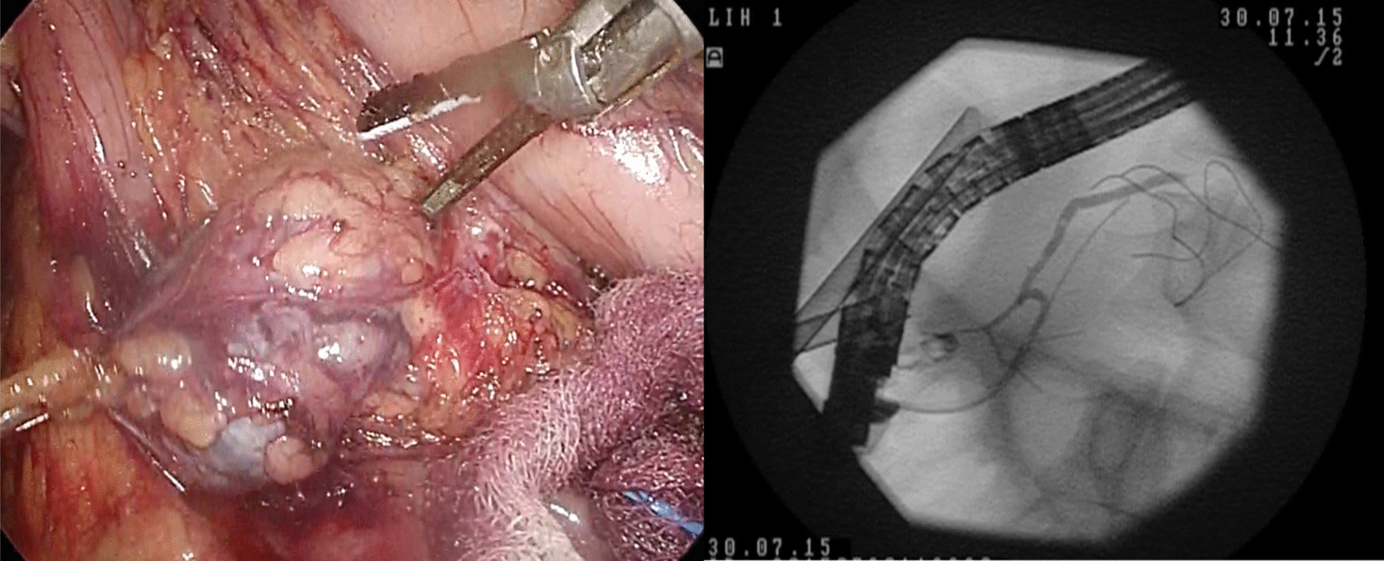 Comprehensive Insights into Solid Pseudopapillary Neoplasms of the Pancreas: A Single Center Experience of 64 Surgical Cases