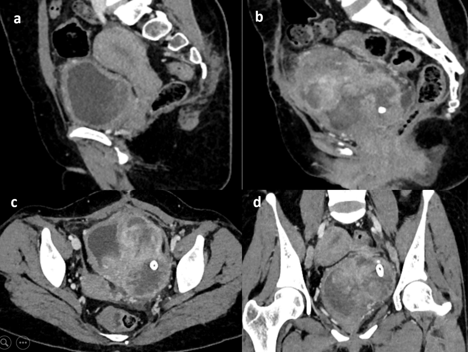 Leiomyosarcoma of the Urinary Bladder: A Rare Diagnosis in Adult Female