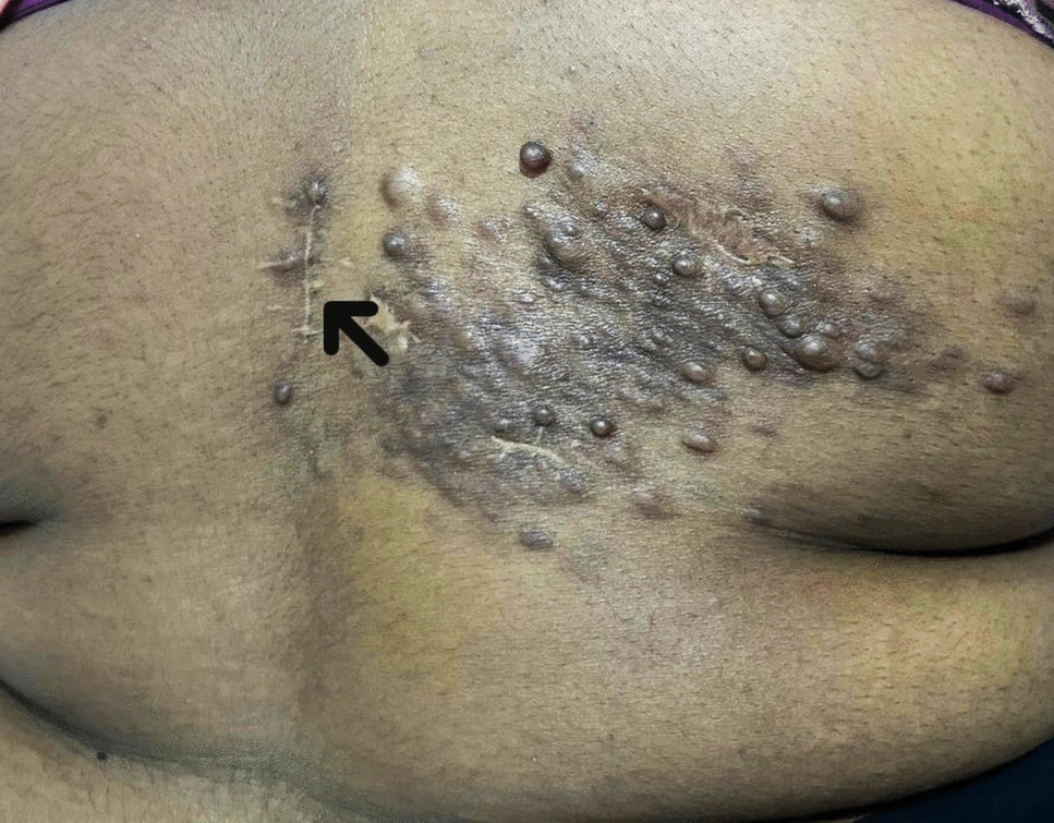Reed Syndrome