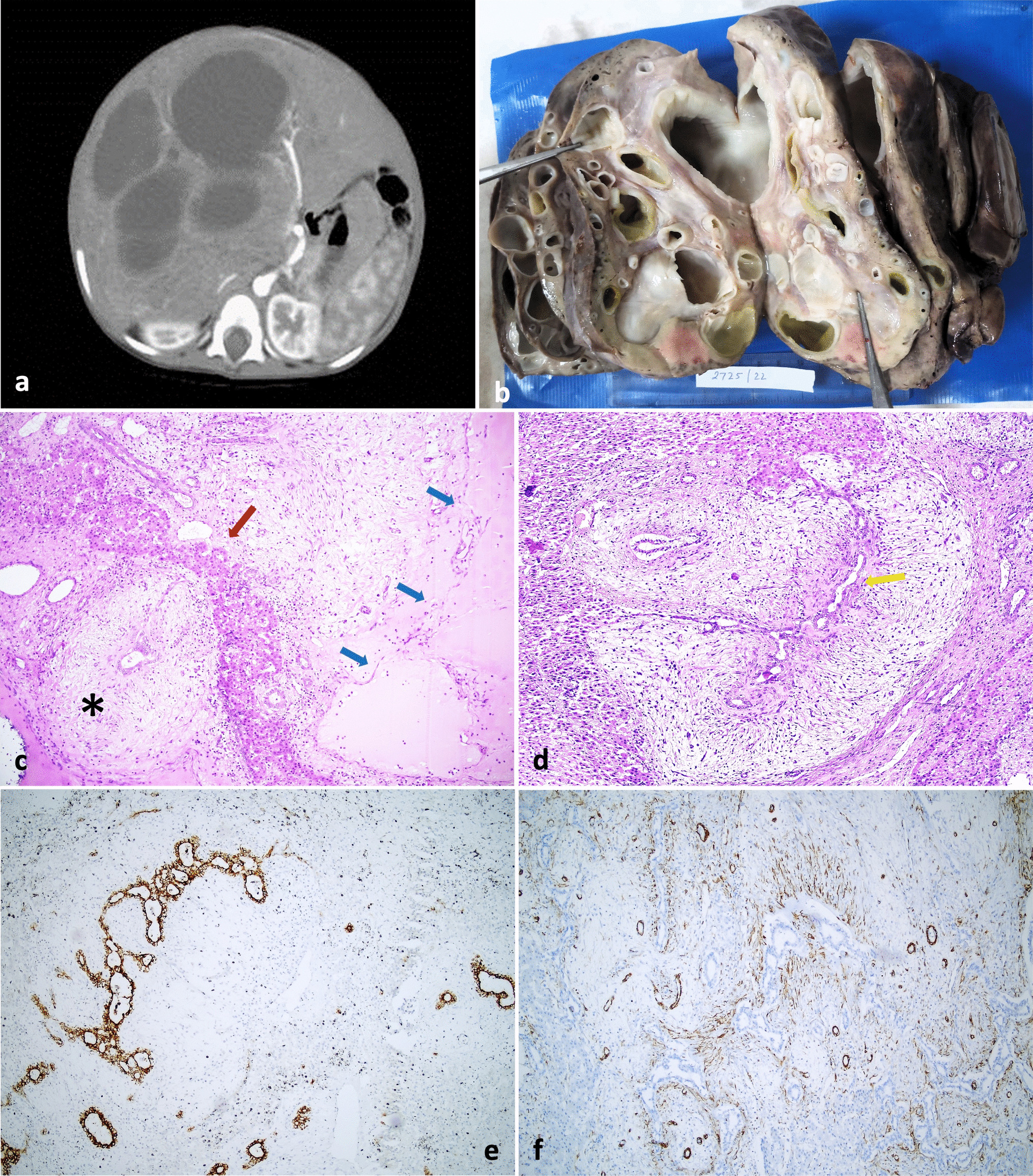 Mesenchymal Hamartoma of the Liver: A Clinicopathological Analysis of Patients at a Tertiary Care Facility
