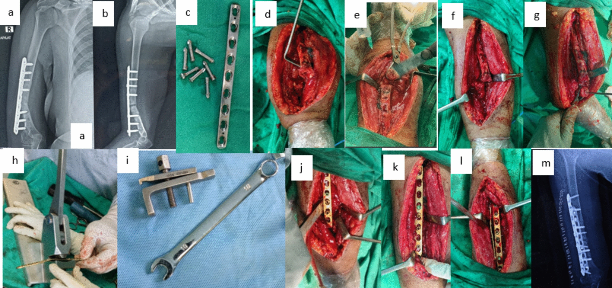 Functional Outcomes in Aseptic Humeral Shaft Nonunion Treated With Plate Osteosynthesis: A Retrospective Cohort Study
