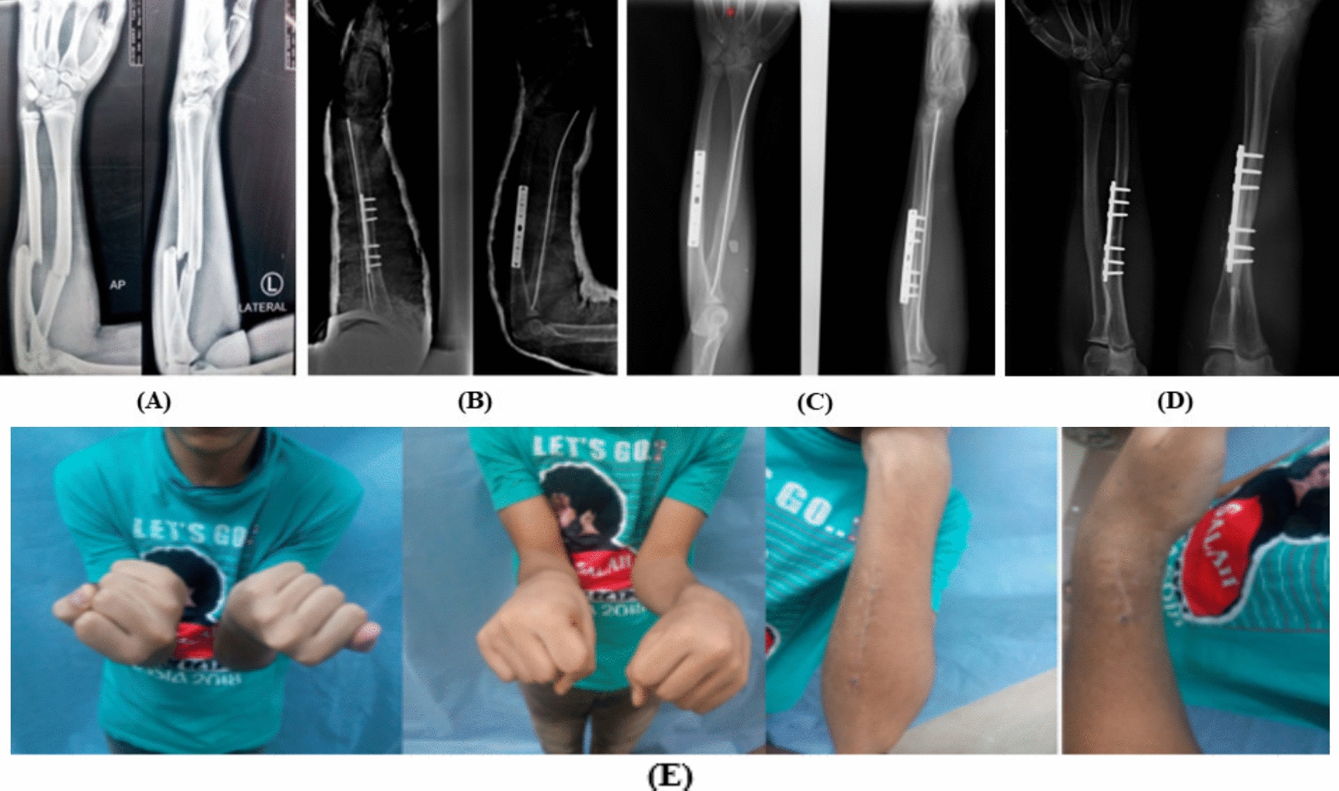 Effectiveness of Hybrid Fixation in the Treatment of Proximal Diaphyseal Both Bone Forearm Fractures in Adolescents