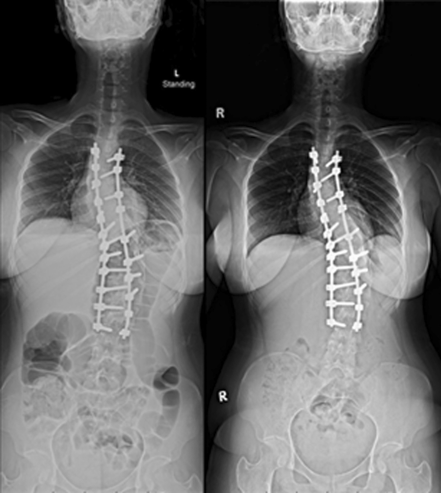 Incidence of and Factors Associated with Spontaneous Correction of Postoperative Shoulder Imbalance in Adolescent Idiopathic Scoliosis Patients: A Retrospective Cohort Study