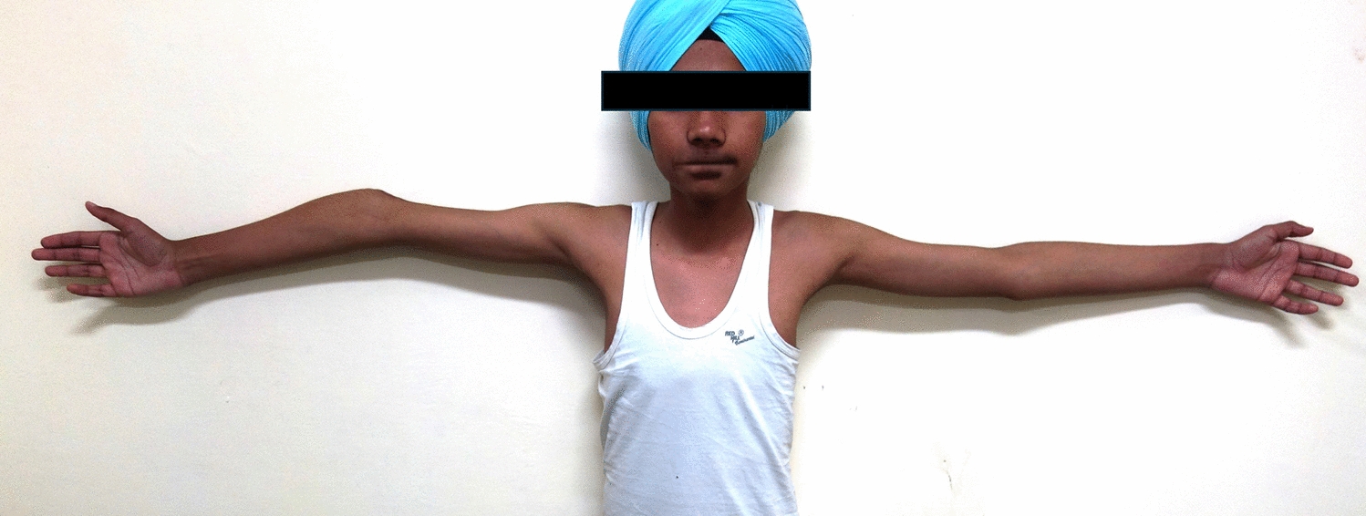 Efficacy and Complications of External Fixator-Assisted Correction in Cubitus Varus Deformity