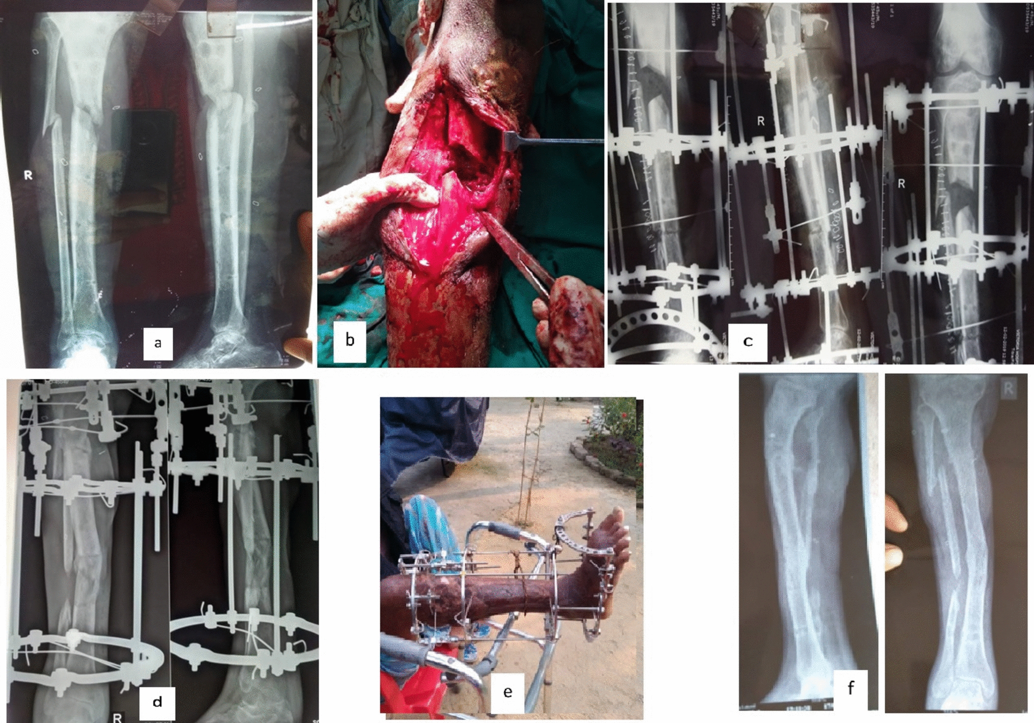 Study of Factors Affecting the Clinical and Radiological Outcome in Management of Infected Non-Union of Tibia Managed with Ilizarov Ring Fixator and its Correlation with Patient-Reported Outcome: Prospective Descriptive Study
