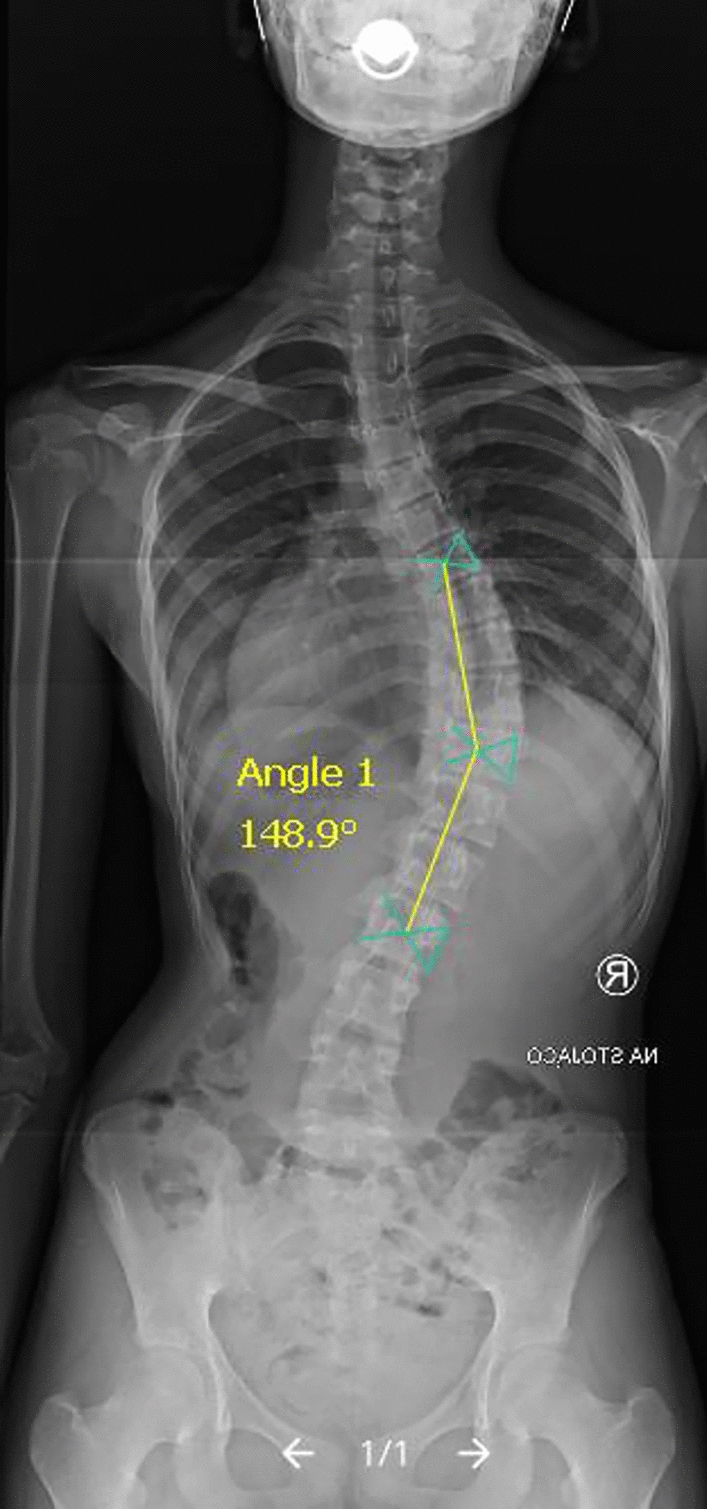 Which Method of the Radiologic Measurements of the Angle of Curvature in Idiopathic Scoliosis is the Most Reliable for an Inexperienced Researcher?